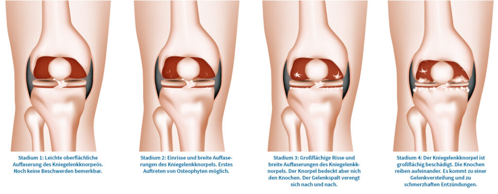 Wie Lange Ist Ein Knie Nach Op Geschwollen www.klinik-eichholz.de