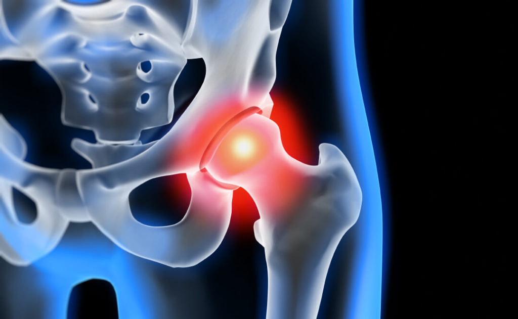 Knie Arthrose - Ursache, Symptome und Behandlung